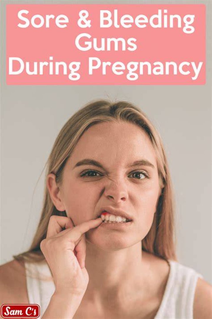 Can Bleeding Gums be a sign of early pregnancy