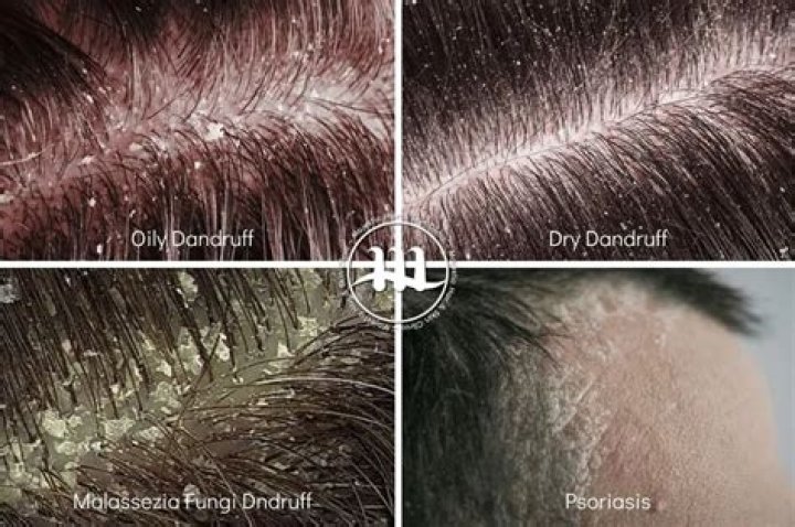 Can dandruff be sticky