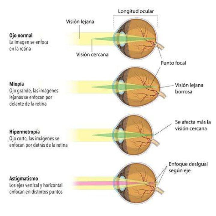 ¿Cómo se corrige la miopía y el astigmatismo