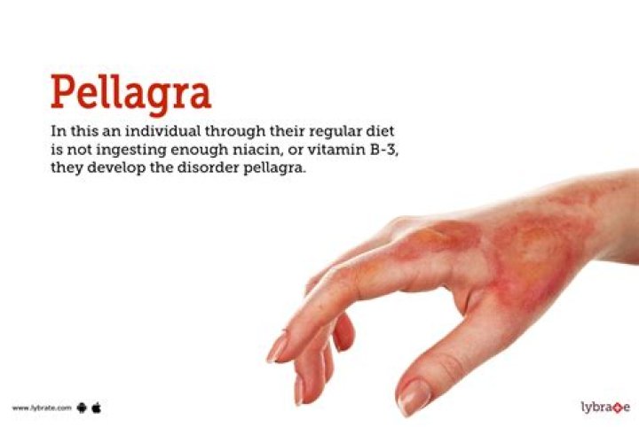 How can pellagra be cured