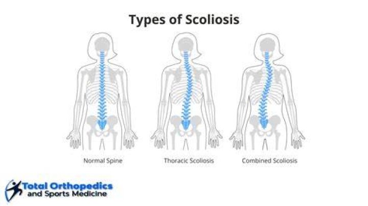 How common is scoliosis in boys