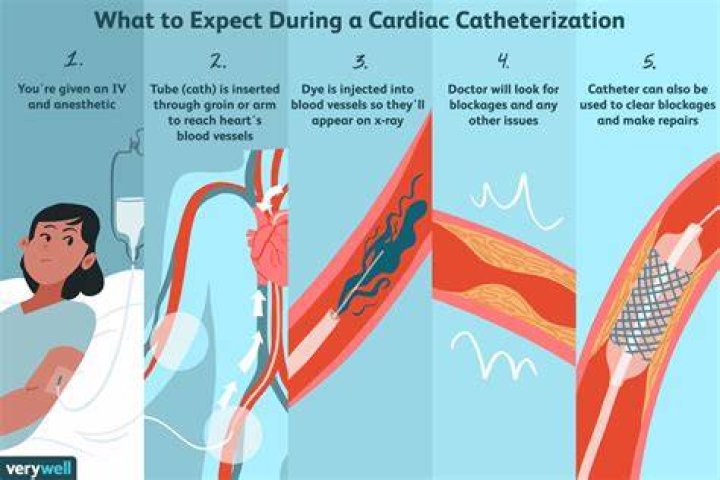 How do you code a cardiac catheterization