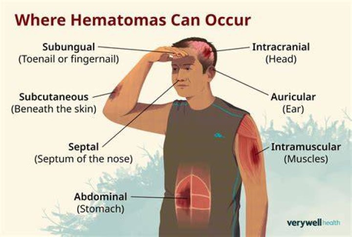 Is a hematoma serious