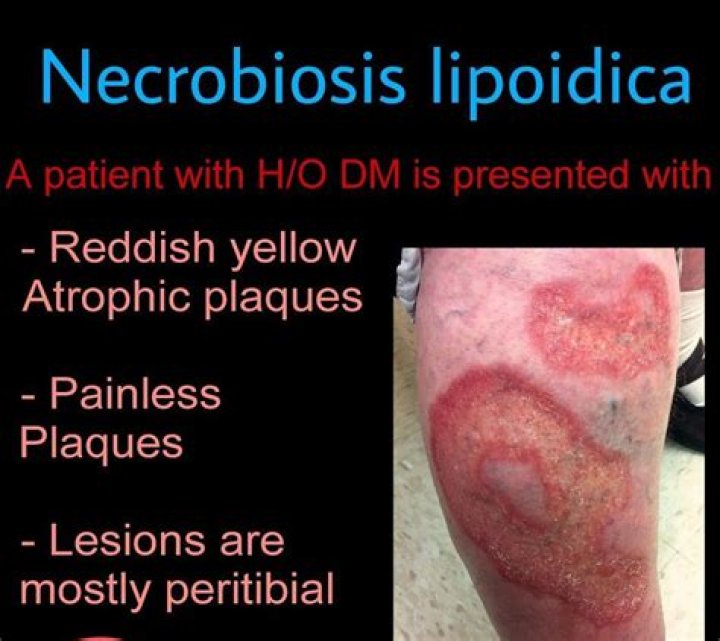 Is there a cure for Necrobiosis Lipoidica