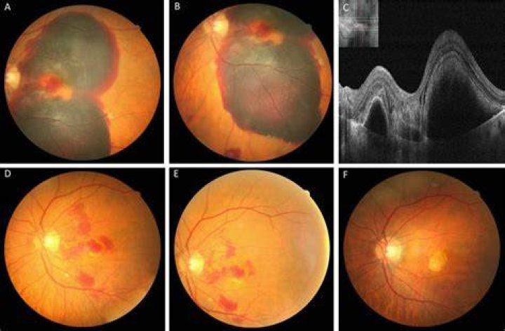 What causes macular hemorrhage
