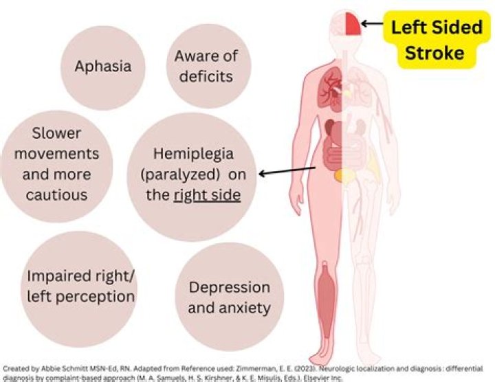 What type of stroke causes left sided weakness