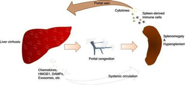 Why does cirrhosis cause Hypersplenism